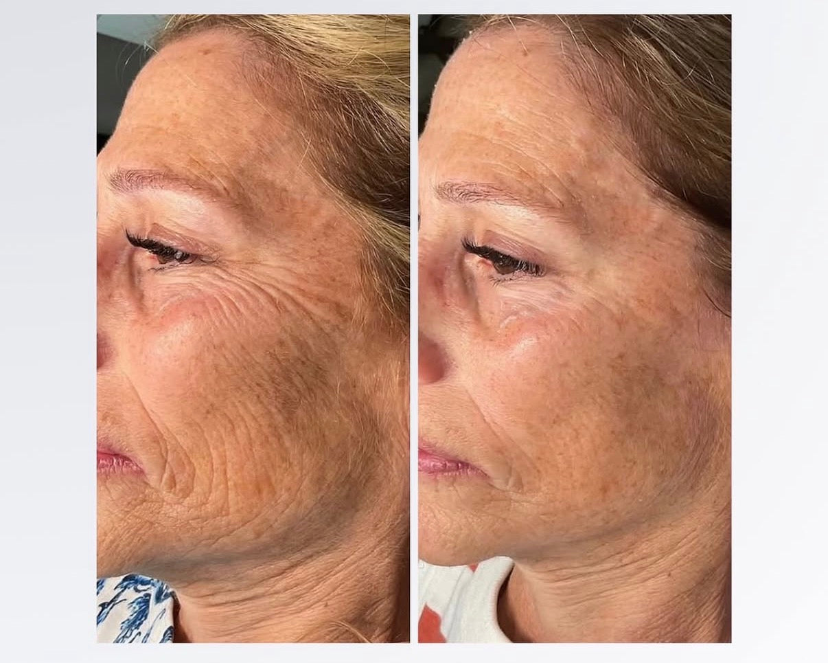 (Second Presale) Spalina Italian Glow Treatment Series