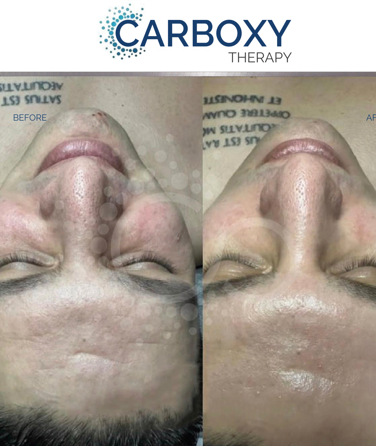 (New) Spalina CO2 Plasma Renewal Facial Series ($150 intro OFF)