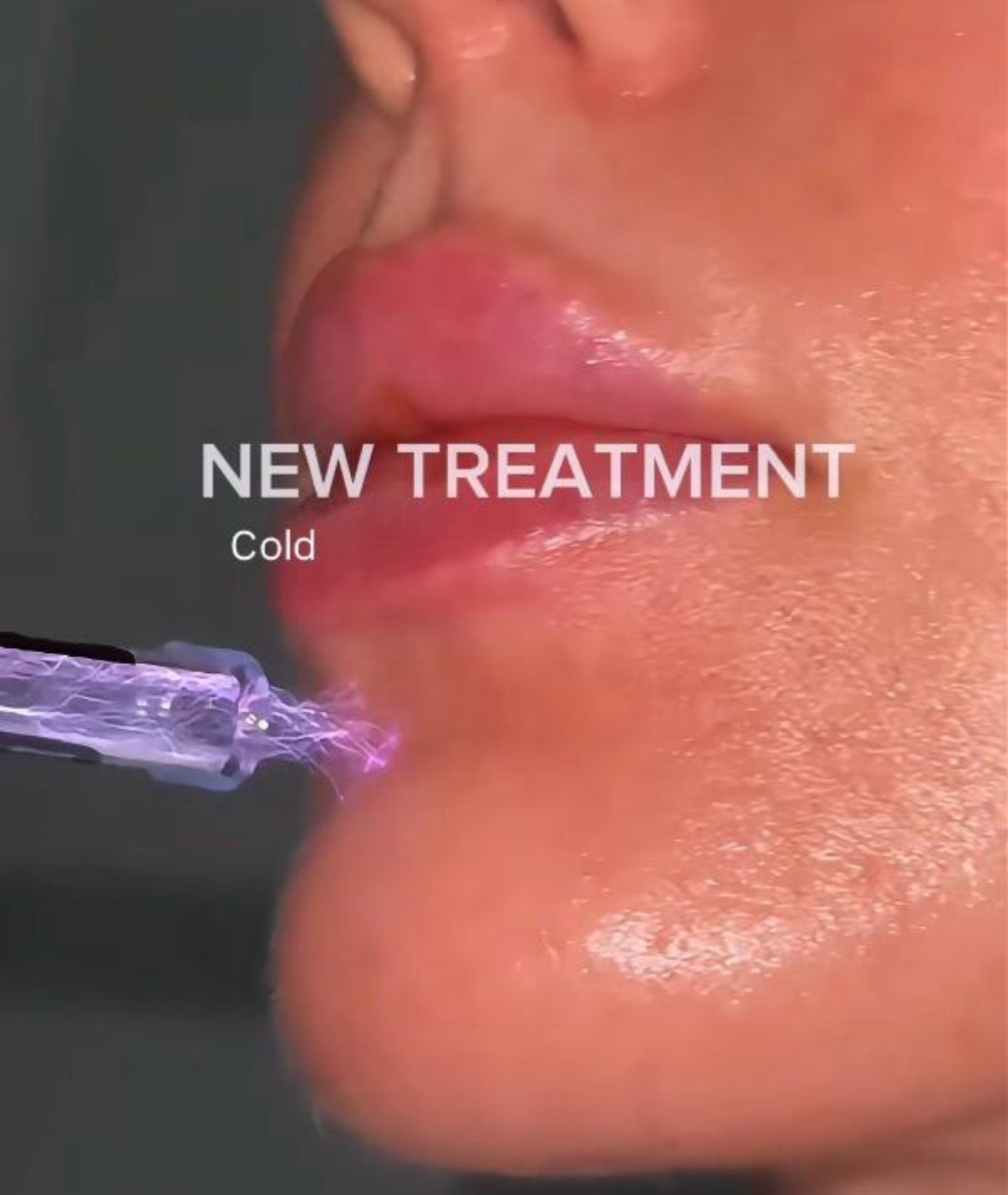 (New) Spalina CO2 Plasma Renewal Facial Series ($150 intro OFF)
