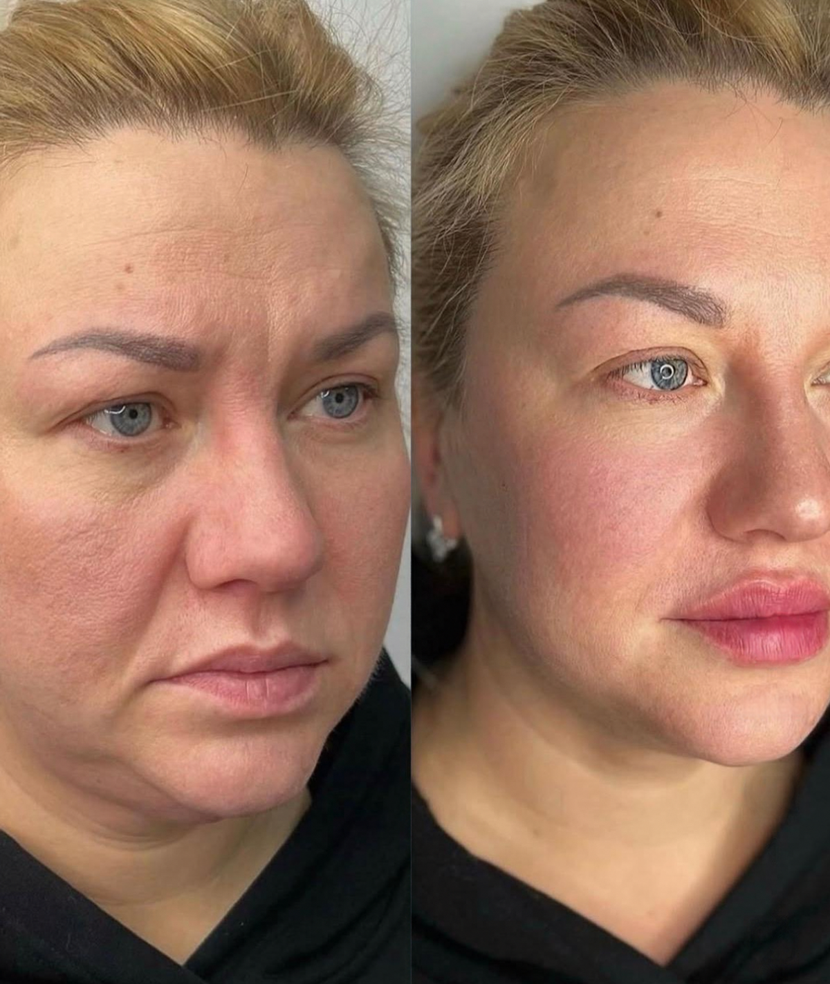 (New) Spalina CO2 Plasma Renewal Facial Series ($150 intro OFF)